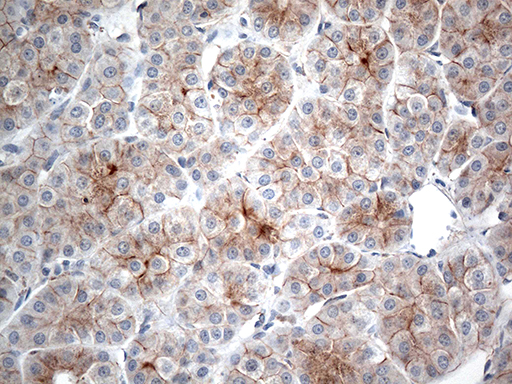 CRF2-12 / IL28RA Antibody - Immunohistochemical staining of paraffin-embedded Carcinoma of Human liver tissue using anti-IFNLR1 mouse monoclonal antibody. (Heat-induced epitope retrieval by 1mM EDTA in 10mM Tris buffer. (pH8.5) at 120°C for 3 min. (1:500)