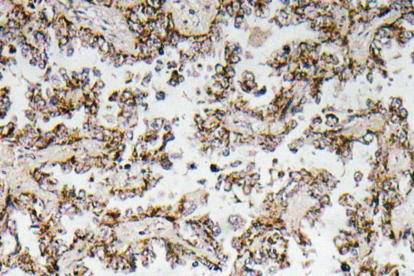 CRH / CRF Antibody - IHC of CRF (R153) pAb in paraffin-embedded human lung carcinoma tissue.
