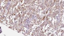 CRH / CRF Antibody - 1:100 staining human Melanoma tissue by IHC-P. The sample was formaldehyde fixed and a heat mediated antigen retrieval step in citrate buffer was performed. The sample was then blocked and incubated with the antibody for 1.5 hours at 22°C. An HRP conjugated goat anti-rabbit antibody was used as the secondary.