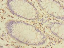 CRIP1 Antibody - Immunohistochemistry of paraffin-embedded human colon cancer at dilution 1:100