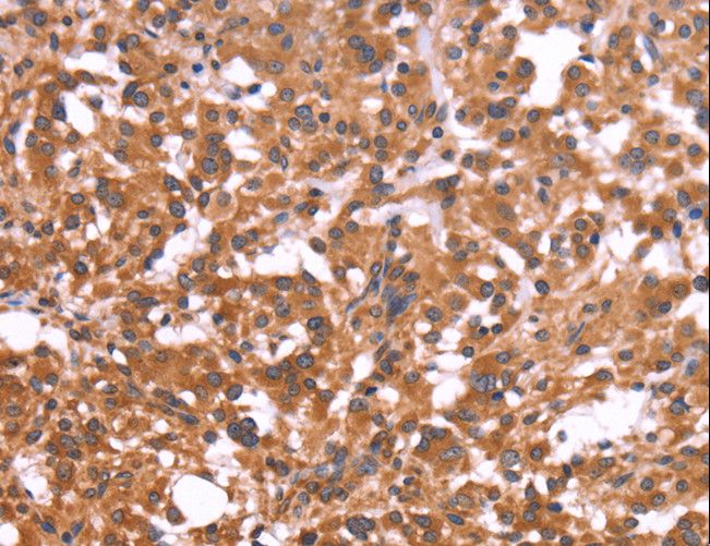 CRISP3 Antibody - Immunohistochemistry of paraffin-embedded Human colon cancer using CRISP3 Polyclonal Antibody at dilution of 1:50.