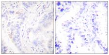 CRK Antibody - Immunohistochemistry analysis of paraffin-embedded human lung carcinoma tissue, using CrkII Antibody. The picture on the right is blocked with the synthesized peptide.