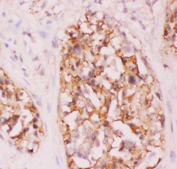 CRK Antibody - Crk p38 antibody IHC-paraffin: Human Lung Cancer Tissue.
