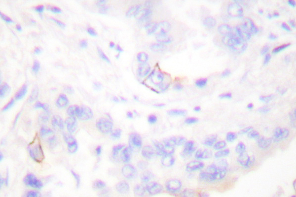 CRK Antibody - IHC of CrkII (P215) pAb in paraffin-embedded human lung carcinoma tissue.