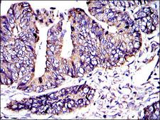 CRK Antibody - IHC of paraffin-embedded rectum cancer tissues using CRK mouse monoclonal antibody with DAB staining.