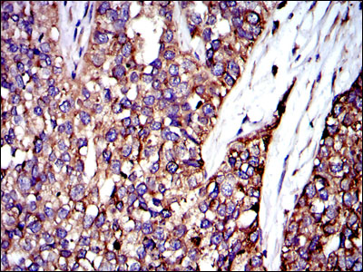 CRK Antibody - IHC of paraffin-embedded bladder cancer tissues using CRK mouse monoclonal antibody with DAB staining.