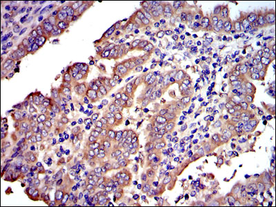 CRK Antibody - IHC of paraffin-embedded intima cancer tissues using CRK mouse monoclonal antibody with DAB staining.