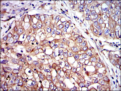 CRK Antibody - IHC of paraffin-embedded lung cancer tissues using CRK mouse monoclonal antibody with DAB staining.