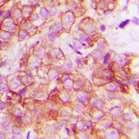 CRK Antibody - Immunohistochemical analysis of CRK staining in human breast cancer formalin fixed paraffin embedded tissue section. The section was pre-treated using heat mediated antigen retrieval with sodium citrate buffer (pH 6.0). The section was then incubated with the antibody at room temperature and detected using an HRP conjugated compact polymer system. DAB was used as the chromogen. The section was then counterstained with hematoxylin and mounted with DPX.