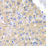 CRK Antibody - Immunohistochemistry of paraffin-embedded human liver cancer using CRK antibodyat dilution of 1:200 (40x lens).