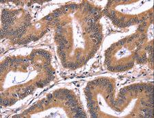 CRK Antibody - Immunohistochemistry of paraffin-embedded Human colon cancer using CRK Polyclonal Antibody at dilution of 1:50.