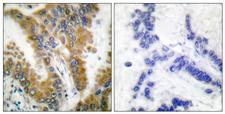 CRKL Antibody - Immunohistochemistry analysis of paraffin-embedded human lung carcinoma tissue, using CrkL Antibody. The picture on the right is blocked with the synthesized peptide.