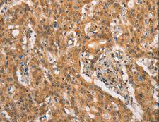 CRKL Antibody - Immunohistochemistry of paraffin-embedded Human gastric cancer using CRKL Polyclonal Antibody at dilution of 1:25.
