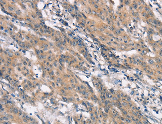 CRKL Antibody - Immunohistochemistry of paraffin-embedded Human gastric cancer using CRKL Polyclonal Antibody at dilution of 1:25.