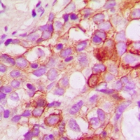 CRKL Antibody - Immunohistochemical analysis of CRKL staining in human breast cancer formalin fixed paraffin embedded tissue section. The section was pre-treated using heat mediated antigen retrieval with sodium citrate buffer (pH 6.0). The section was then incubated with the antibody at room temperature and detected using an HRP conjugated compact polymer system. DAB was used as the chromogen. The section was then counterstained with haematoxylin and mounted with DPX.