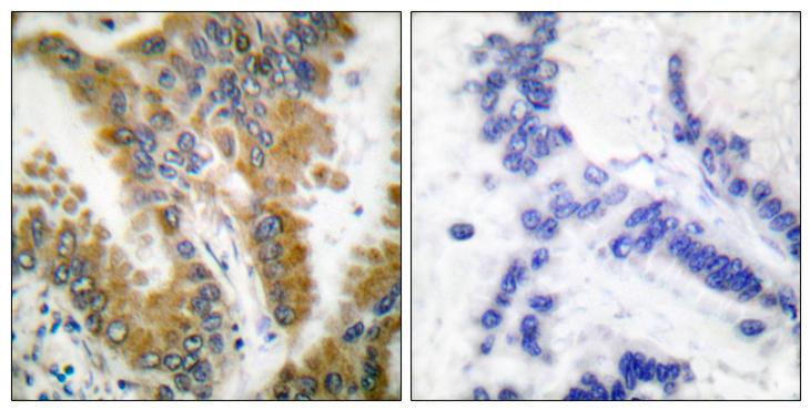 CRKL Antibody - Peptide - + Immunohistochemical analysis of paraffin-embedded human lung carcinoma tissue, using CrkL (Ab-207) antibody.