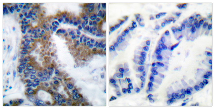 CRKL Antibody - Immunohistochemistry analysis of paraffin-embedded human lung carcinoma, using CrkL (Phospho-Tyr207) Antibody. The picture on the right is blocked with the phospho peptide.
