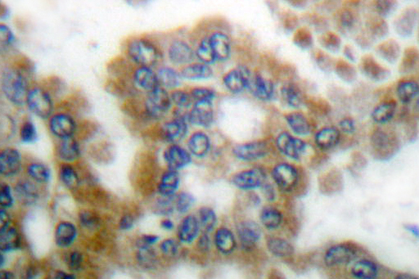 CRKL Antibody - IHC of CrkL (P201) pAb in paraffin-embedded human lung carcinoma tissue.