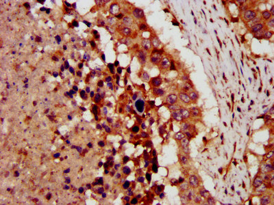 CRLF1 Antibody - Immunohistochemistry image at a dilution of 1:300 and staining in paraffin-embedded human lung cancer performed on a Leica BondTM system. After dewaxing and hydration, antigen retrieval was mediated by high pressure in a citrate buffer (pH 6.0) . Section was blocked with 10% normal goat serum 30min at RT. Then primary antibody (1% BSA) was incubated at 4 °C overnight. The primary is detected by a biotinylated secondary antibody and visualized using an HRP conjugated SP system.