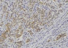 CRLF1 Antibody - 1:100 staining human lung carcinoma tissue by IHC-P. The sample was formaldehyde fixed and a heat mediated antigen retrieval step in citrate buffer was performed. The sample was then blocked and incubated with the antibody for 1.5 hours at 22°C. An HRP conjugated goat anti-rabbit antibody was used as the secondary.