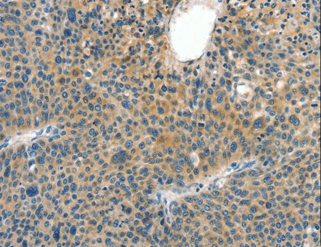CRLF2 / TSLPR Antibody - Immunohistochemistry of paraffin-embedded Human thyroid cancer using CRLF2 Polyclonal Antibody at dilution of 1:60.