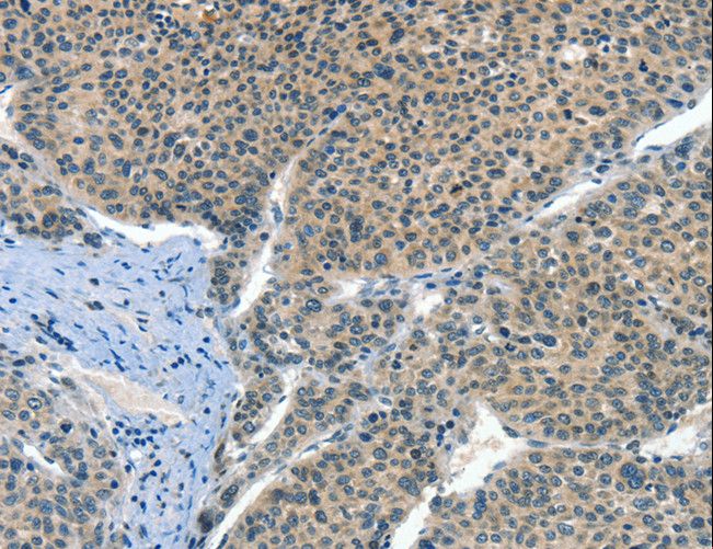 CRLF2 / TSLPR Antibody - Immunohistochemistry of paraffin-embedded Human liver cancer using CRLF2 Polyclonal Antibody at dilution of 1:60.