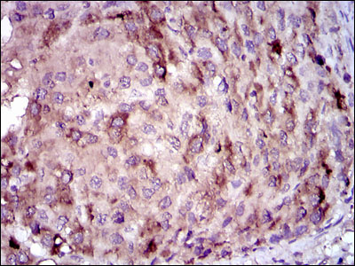 CRP / C-Reactive Protein Antibody - IHC of paraffin-embedded liver cancer tissues using CRP mouse monoclonal antibody with DAB staining.