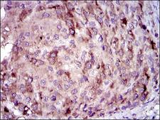 CRP / C-Reactive Protein Antibody - IHC of paraffin-embedded liver cancer tissues using CRP mouse monoclonal antibody with DAB staining.