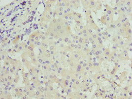 CRP / C-Reactive Protein Antibody - Immunohistochemistry of paraffin-embedded human liver cancer using CRP Antibody at dilution of 1:100