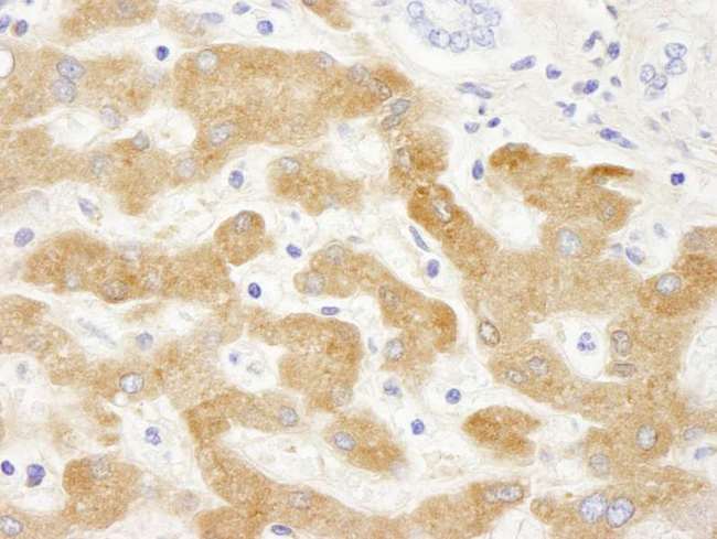 CRP / C-Reactive Protein Antibody - Detection of Human C-Reactive Protein by Immunohistochemistry. Sample: FFPE section of human liver. Antibody: Affinity purified goat anti-C-Reactive Protein used at a dilution of 1:250 Detection: DAB.