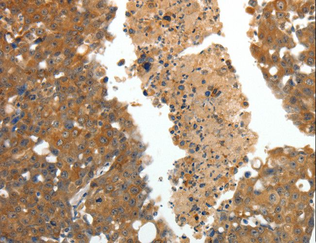 CRP / C-Reactive Protein Antibody - Immunohistochemistry of paraffin-embedded Human breast cancer using CRP Polyclonal Antibody at dilution of 1:80.