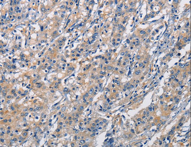 CRTAM Antibody - Immunohistochemistry of paraffin-embedded Human gastric cancer using CRTAM Polyclonal Antibody at dilution of 1:60.