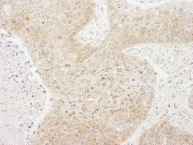 CRTC1 / MECT1 / TORC1 Antibody - Detection of Human TORC1 by Immunohistochemistry. Sample: FFPE section of human lung carcinoma. Antibody: Affinity purified rabbit anti-TORC1 used at a dilution of 1:250. Epitope Retrieval Buffer-High pH (IHC-101J) was substituted for Epitope Retrieval Buffer-Reduced pH.