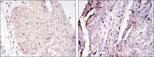 CRTC2 / TORC2 Antibody - IHC of paraffin-embedded ovary tumor tissues (left) and lung cancer (right) using CRTC2 mouse monoclonal antibody with DAB staining.
