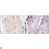 CRTC2 / TORC2 Antibody - Immunohistochemistry (IHC) analysis of paraffin-embedded ovary tumour tissues (left) and lung cancer (right) with DAB staining using TORC2 Monoclonal Antibody.