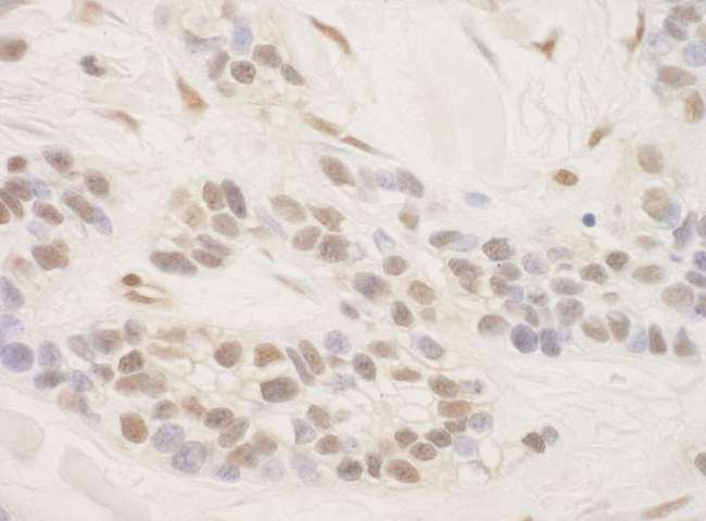 CRTC3 Antibody - Detection of Human TORC3 by Immunohistochemistry. Sample: FFPE section of human breast carcinoma. Antibody: Affinity purified rabbit anti-TORC3 used at a dilution of 1:250.