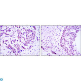 CRTC3 Antibody - Immunohistochemistry (IHC) analysis of paraffin-embedded breast cancer (left) and ovarian cancer (right) with DAB staining using TORC3 Monoclonal Antibody.