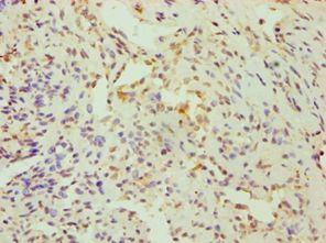 CRY1 Antibody - Immunohistochemistry of paraffin-embedded human breast cancer using antibody at 1:100 dilution.