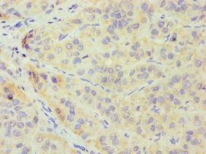 CRY1 Antibody - Immunohistochemistry of paraffin-embedded human liver cancer using antibody at 1:100 dilution.
