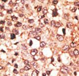 CRY1 Antibody - Formalin-fixed and paraffin-embedded human cancer tissue reacted with the primary antibody, which was peroxidase-conjugated to the secondary antibody, followed by AEC staining. This data demonstrates the use of this antibody for immunohistochemistry; clinical relevance has not been evaluated. BC = breast carcinoma; HC = hepatocarcinoma.