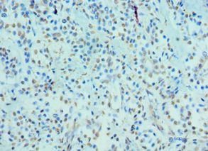 CRY2 Antibody - Immunohistochemistry of paraffin-embedded human breast cancer using antibody at 1:100 dilution.