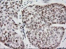 CRY2 Antibody - IHC of paraffin-embedded Adenocarcinoma of Human breast tissue using anti-CRY2 mouse monoclonal antibody. (Heat-induced epitope retrieval by 10mM citric buffer, pH6.0, 100C for 10min).