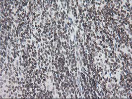 CRY2 Antibody - IHC of paraffin-embedded Human lymphoma tissue using anti-CRY2 mouse monoclonal antibody. (Heat-induced epitope retrieval by 10mM citric buffer, pH6.0, 100C for 10min).