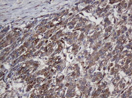 CRYAA / Alpha A Crystallin Antibody - IHC of paraffin-embedded Carcinoma of Human liver tissue using anti-CRYAA mouse monoclonal antibody.