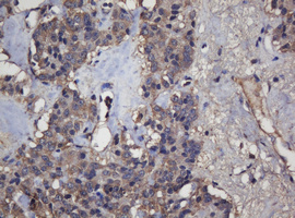 CRYAA / Alpha A Crystallin Antibody - IHC of paraffin-embedded Carcinoma of Human pancreas tissue using anti-CRYAA mouse monoclonal antibody.