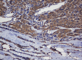 CRYAA / Alpha A Crystallin Antibody - IHC of paraffin-embedded Carcinoma of Human thyroid tissue using anti-CRYAA mouse monoclonal antibody.