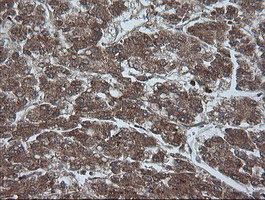 CRYAA / Alpha A Crystallin Antibody - IHC of paraffin-embedded Carcinoma of Human liver tissue using anti-CRYAA mouse monoclonal antibody. (Heat-induced epitope retrieval by 10mM citric buffer, pH6.0, 100C for 10min).