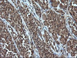 CRYAA / Alpha A Crystallin Antibody - IHC of paraffin-embedded Carcinoma of Human thyroid tissue using anti-CRYAA mouse monoclonal antibody. (Heat-induced epitope retrieval by 10mM citric buffer, pH6.0, 100C for 10min).