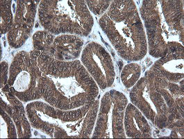 CRYAA / Alpha A Crystallin Antibody - IHC of paraffin-embedded Adenocarcinoma of Human endometrium tissue using anti-CRYAA mouse monoclonal antibody. (Heat-induced epitope retrieval by 10mM citric buffer, pH6.0, 100C for 10min).