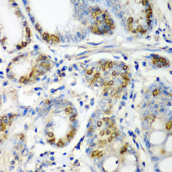 CRYAA / Alpha A Crystallin Antibody - Immunohistochemistry of paraffin-embedded human colon carcinoma tissue.